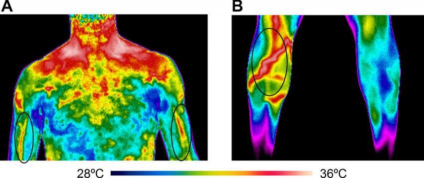 Thermal Imaging in Visualizing Blood Vessels